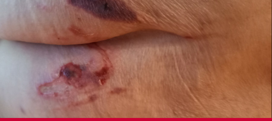 Dekubitus Kategorie 3