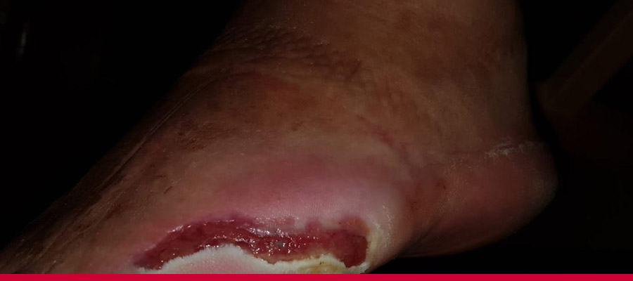 Diabetisches Fusssyndrom